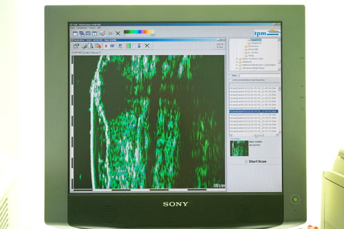 Ein 20-MHz-Ultraschallbild einer Hautveränderung wird auf einem Bildschirm angezeigt